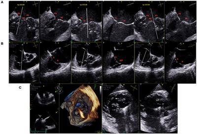 A Practical Approach to Combined Transcatheter Mitral and Tricuspid Valve Intervention